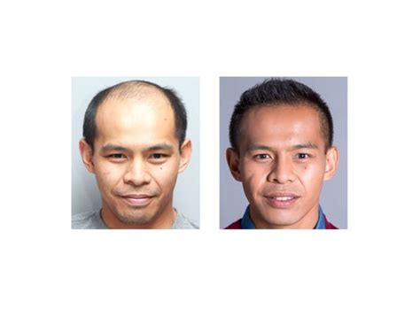 hair replacement st louis|Bosley St. Louis .